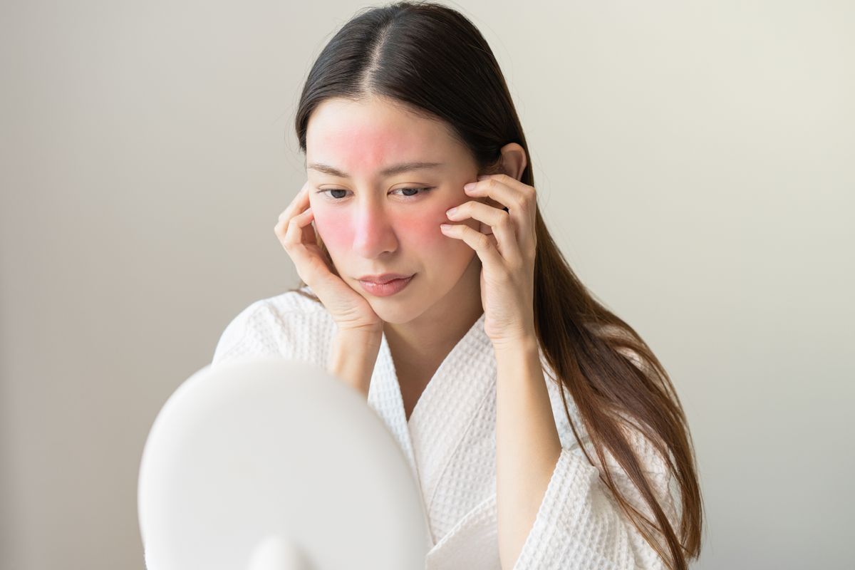 rosacea, bőr, bőrhiba, bőrprobléma, bőrápolás, arcápolás, szépségápolás, piros foltok