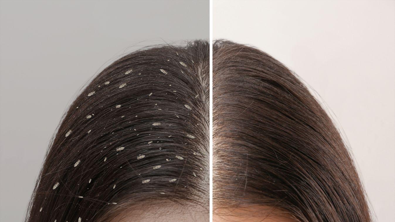 Collage,Showing,Woman's,Hair,Before,And,After,Lice,Treatment,On