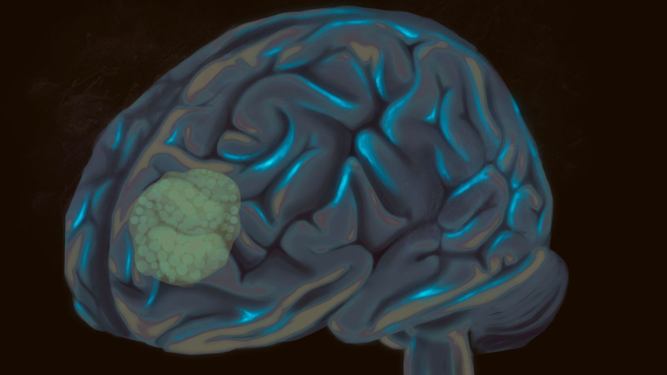 Human,Brain,Tumor,(glioblastoma,Multiforme),On,Frontal,Lobe.