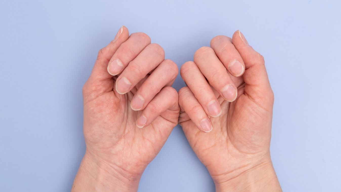 Close-up,Of,Two,Female,Hands,With,Natural,Nails,,Overgrown,Cuticle