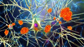 Hajlamosabbak a nők az Alzheimer-kórra? Egy kutatás szerint igen!