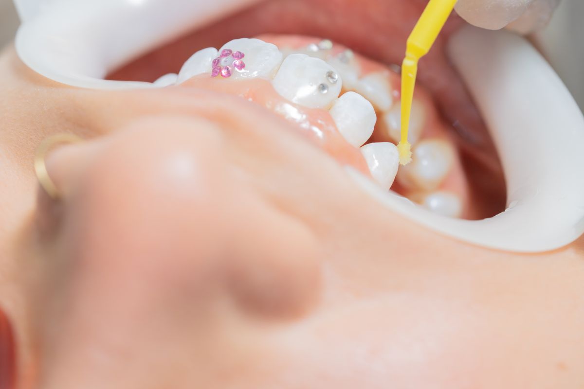 At the dentist teeth with tooth gem, using a mouth opener