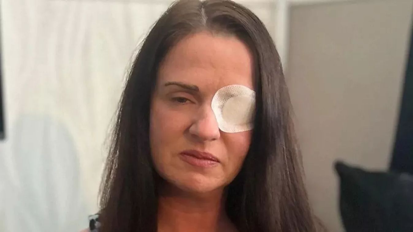 plasztika, illegális botox, szépség