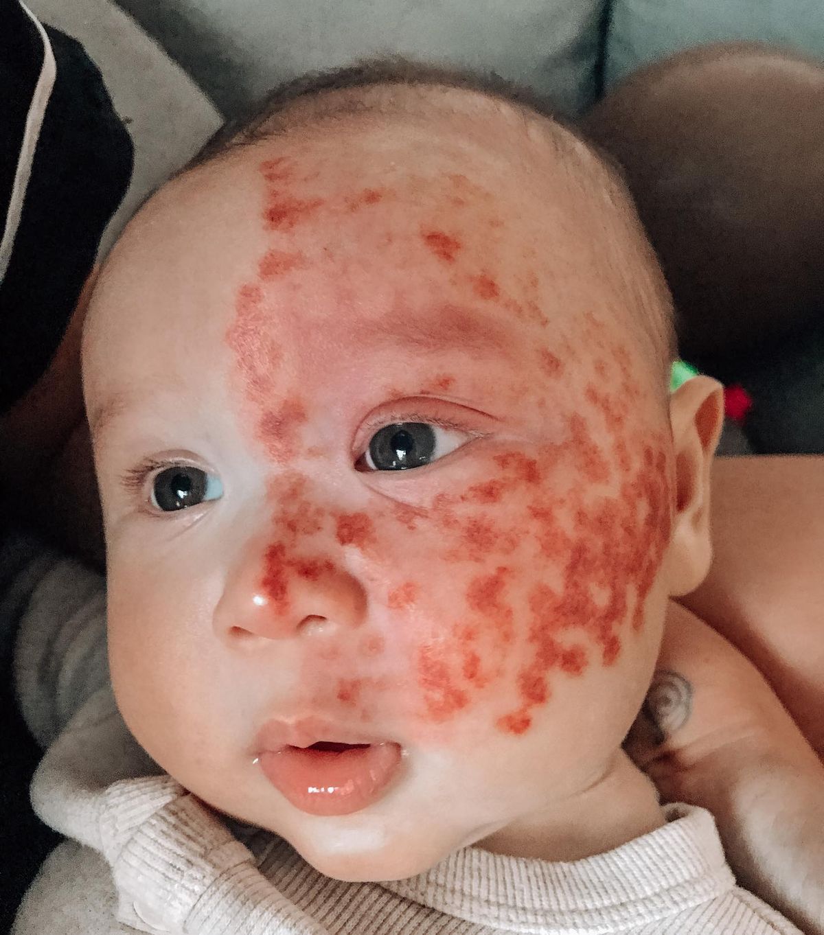 Kingsley tűzfoltokkal született