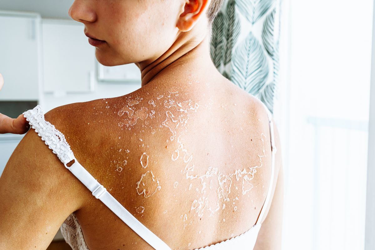 Young beautiful woman view from the back, showing skin burn, flaky skin from sunburn, allergic reaction, dry skin, effects of excessive sunburn, exposure to ultraviolet rays