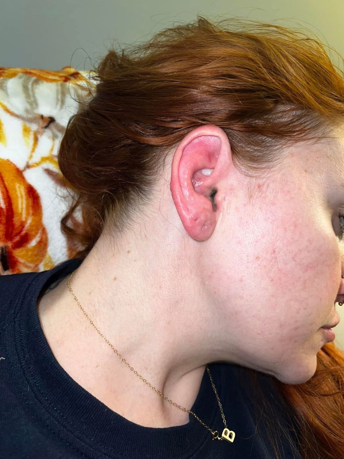 Kennedy News and Media (PIC SHOWS: KELLY STECH, 30, WOKE UP DAYS BEFORE HER WEDDING WITH A SWOLLEN AND BLISTERED RIGHT EAR) A bride became so stressed planning her big day it left her face PARALYSED - and unable to smile in wedding photos. Kelly Stech, who lives in Illinois, Chicago, US, had spent a year organising her dream wedding to her now-husband Benjamin Stech after becoming engaged in July 2022. The couple, who began dating in early-2020 after matching on Tinder, forked out $50,000 on their dream day. DISCLAIMER: While Kennedy News and Media uses its best endeavours to establish the copyright and authenticity of all pictures supplied, it accepts no liability for any damage, loss or legal action caused by the use of images supplied and the publication of images is solely at your discretion. SEE KENNEDY NEWS COPY - 0161 697 4266