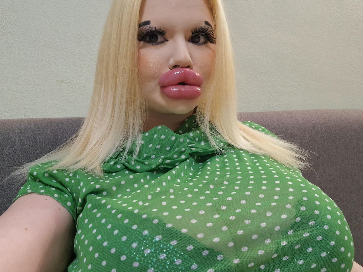 Andrea Emilova Ivanova a szájfeltöltései után