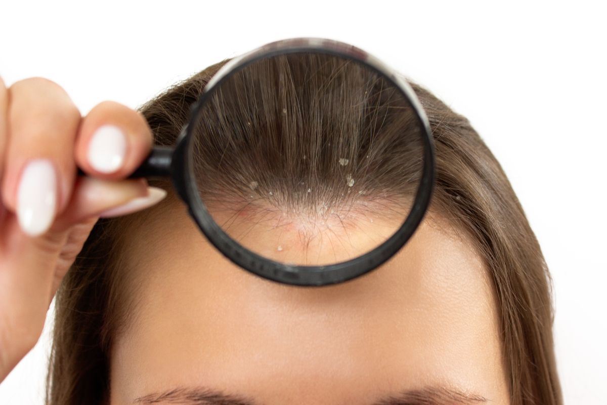 száraz hámló fejbőr