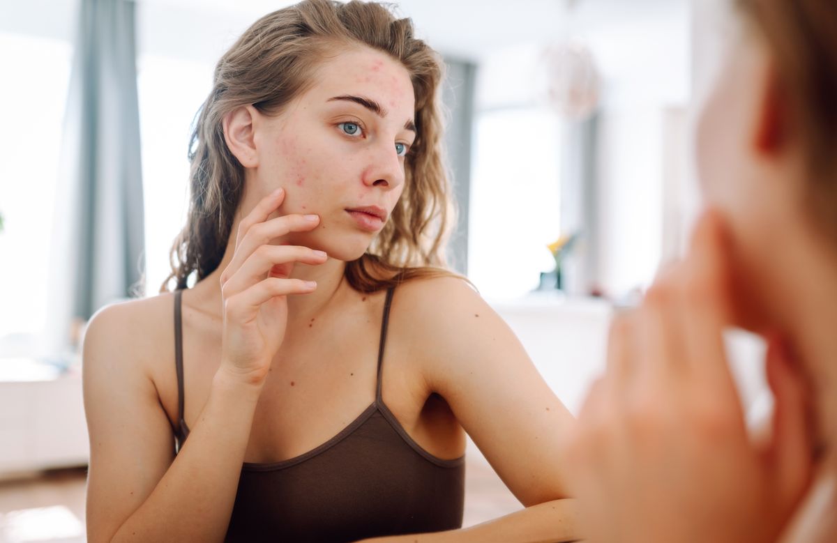 Így különböztesd meg a hormonális aknét a stressz okozta pattanástól