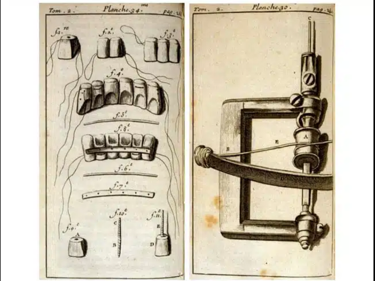  A régi fogszabályzók története