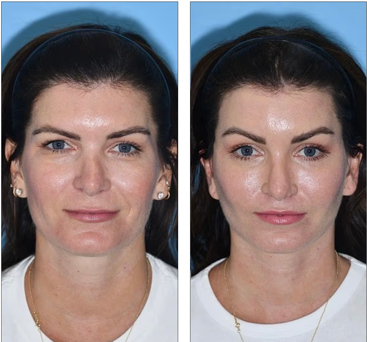 Erica a műtét előtt és után 