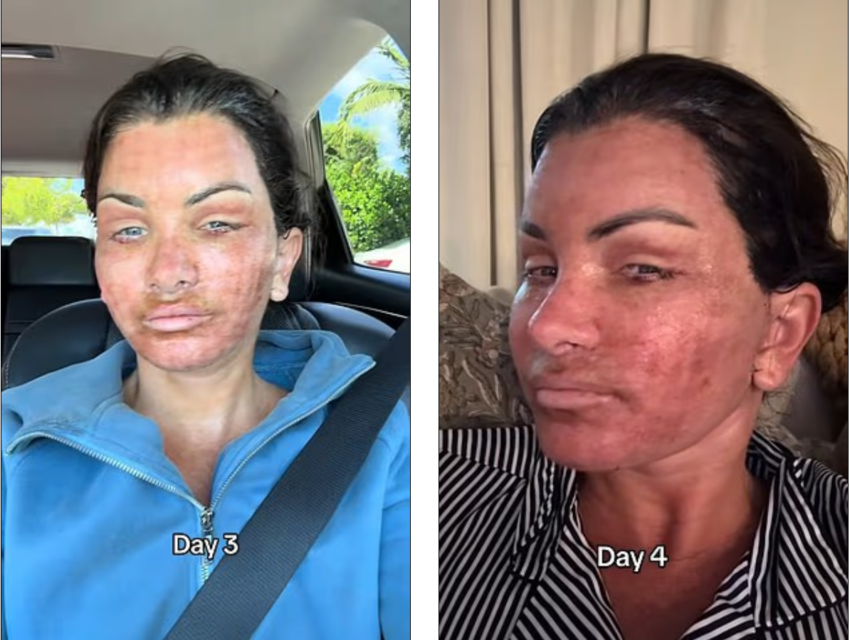 Erica nem sokkal a plasztikai beavatkozás után 