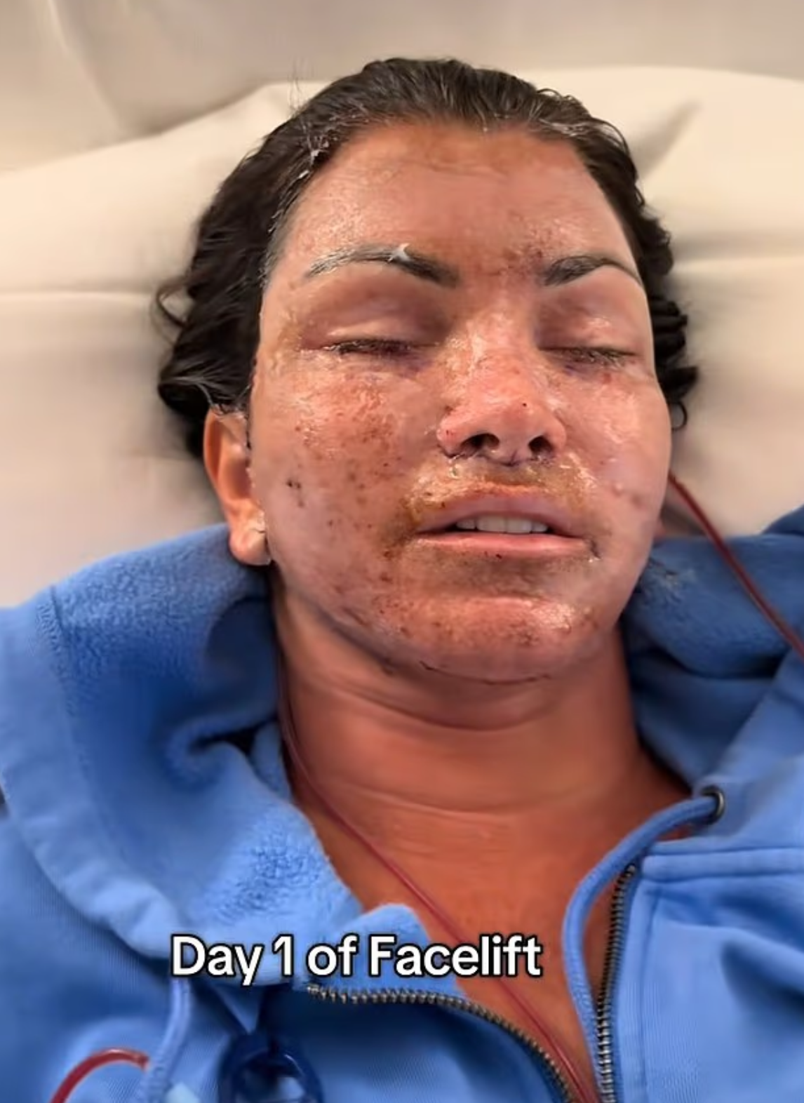 Erice Wolfe az arcplasztika után