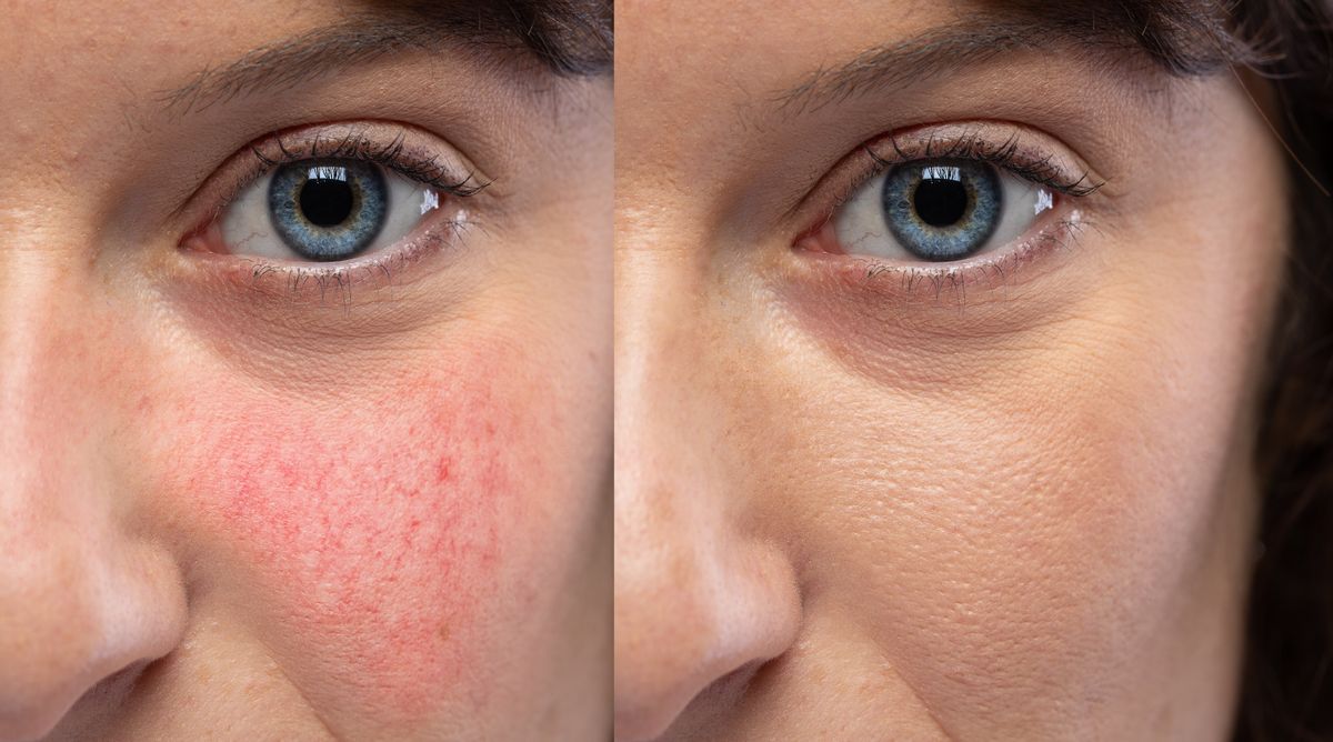 A rosacea kezelése