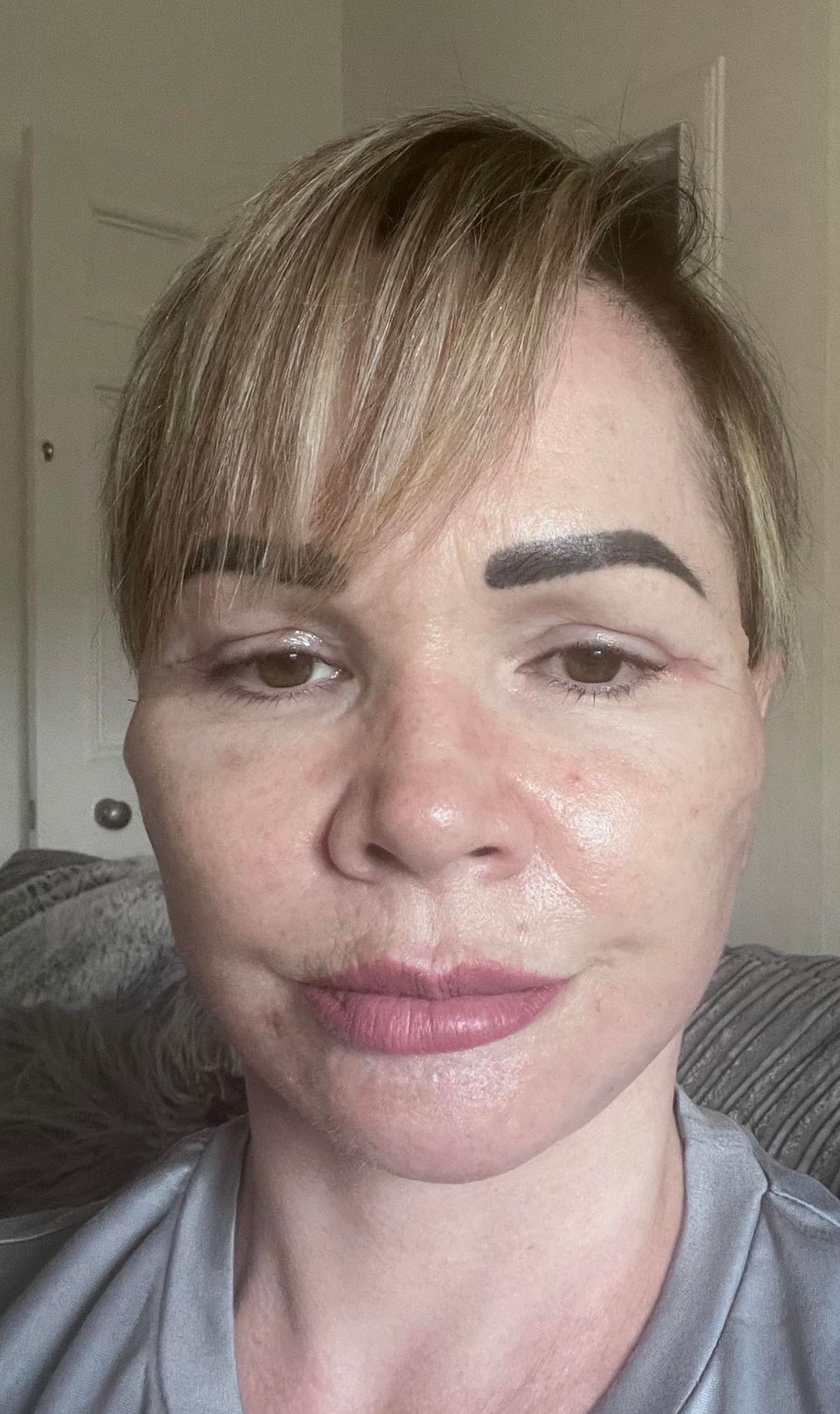 Angela a plasztikai műtét után