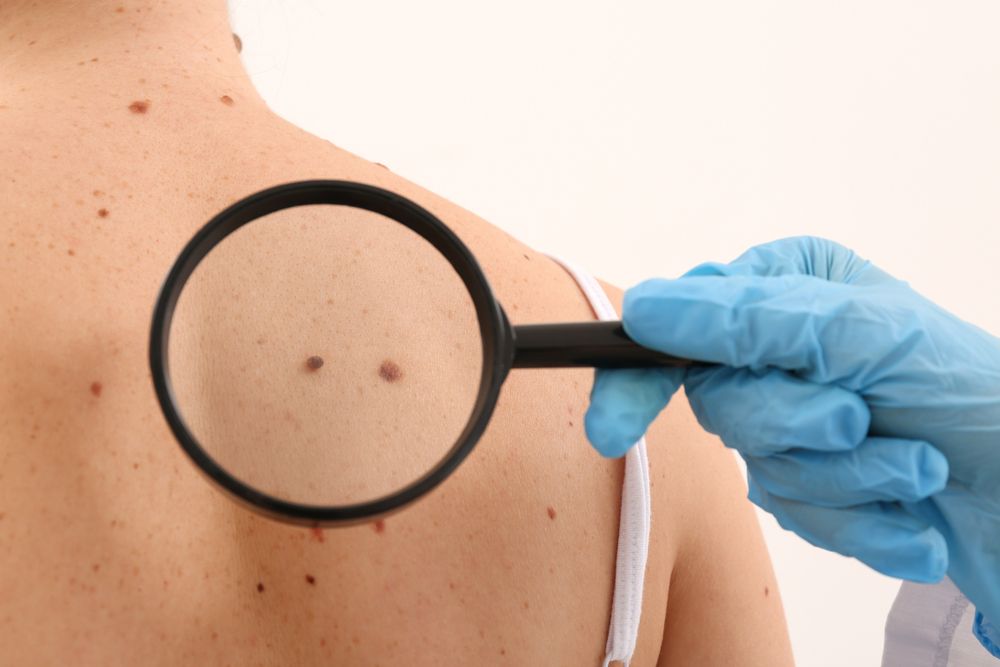 Szoláriumfüggő és a rák