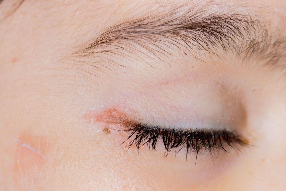 Atkaürülék a szempillán idővel szem- és bőrbetegségekhez vezethet.