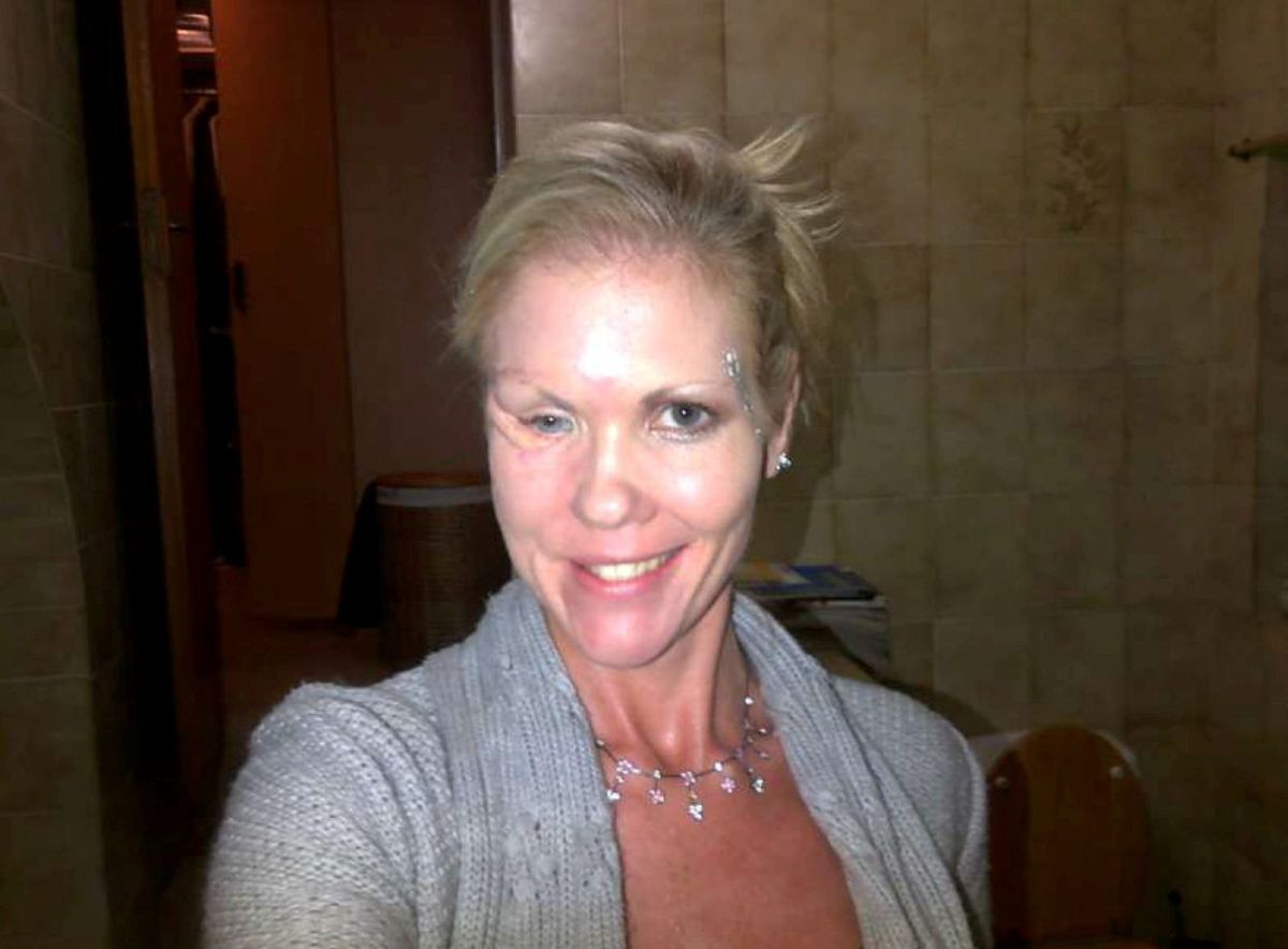 post surgery after the infection was clearing.  A woman who had a facial reconstruction after car a crash has described how an infection saw her new prosthetic eating her face. Vanessa Carter, 47, was involved in a serious car accident in 2004 leaving her with life changing injuries. It included a broken jaw and nose, smashed cheekbones and loss of her right eye. Due to the traumatic collision, Vanessa from Torbay, Devon had to have her face reconstructed and an artificial eye made for her.  She went through several surgeries to remove tissue from the damaged and infected areas and was placed on heavy doses of antibiotics. But after a prosthetic implant was placed to bridge a gap between her cheekbone and nose, she looked in her car’s rearview mirror and saw pus leaking from the cheek where the prosthetic had been inserted. She was told she had an infection which kept coming back and eat away the skin from the side of her face, leaving her terrified as her skin became thinner and weaker each day.
Photo released 28/12/2025