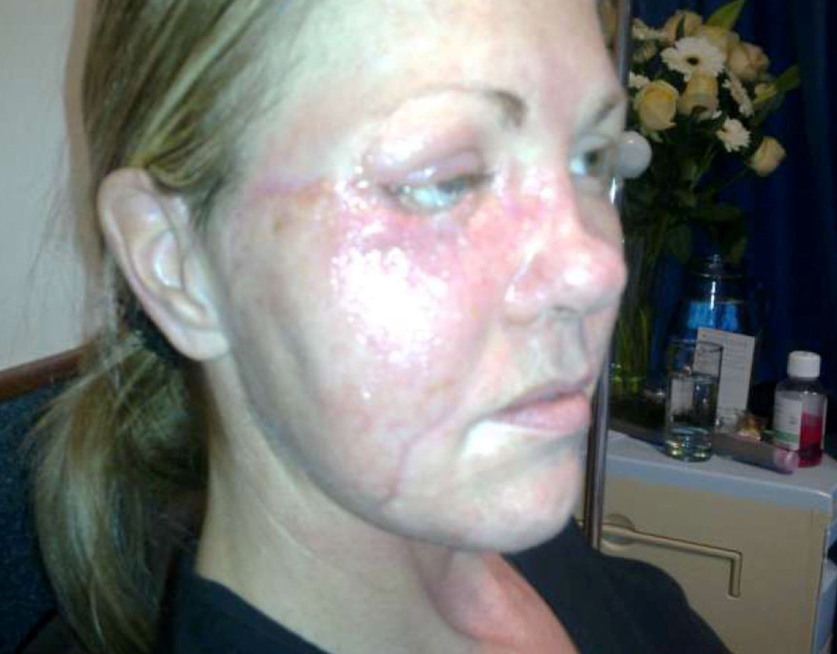 second infection after reconstruction. A woman who had a facial reconstruction after car a crash has described how an infection saw her new prosthetic eating her face. Vanessa Carter, 47, was involved in a serious car accident in 2004 leaving her with life changing injuries. It included a broken jaw and nose, smashed cheekbones and loss of her right eye. Due to the traumatic collision, Vanessa from Torbay, Devon had to have her face reconstructed and an artificial eye made for her.  She went through several surgeries to remove tissue from the damaged and infected areas and was placed on heavy doses of antibiotics. But after a prosthetic implant was placed to bridge a gap between her cheekbone and nose, she looked in her car’s rearview mirror and saw pus leaking from the cheek where the prosthetic had been inserted. She was told she had an infection which kept coming back and eat away the skin from the side of her face, leaving her terrified as her skin became thinner and weaker each day.
Photo released 28/12/2025