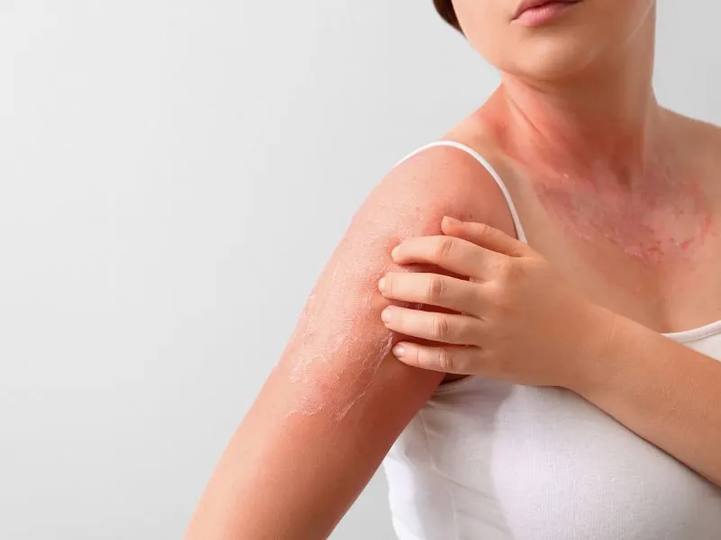 A napallergia megelőzése és kezelése elsősorban a tudatos napozási szokásokon és a bőr védelmén múlik.