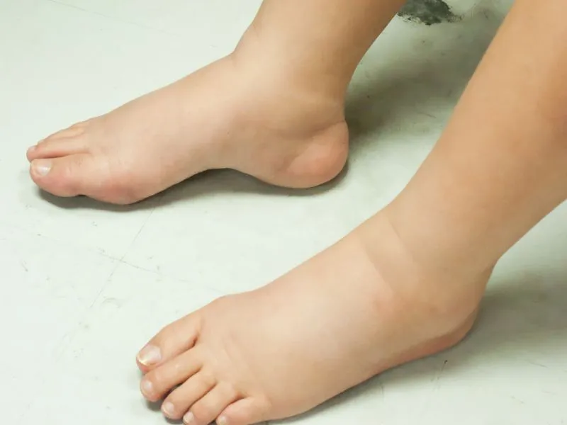 A nyiroködéma a láb duzzanatával is járhat