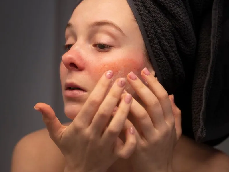 A napallergia megelőzése és kezelése elsősorban a tudatos napozási szokásokon és a bőr védelmén múlik.