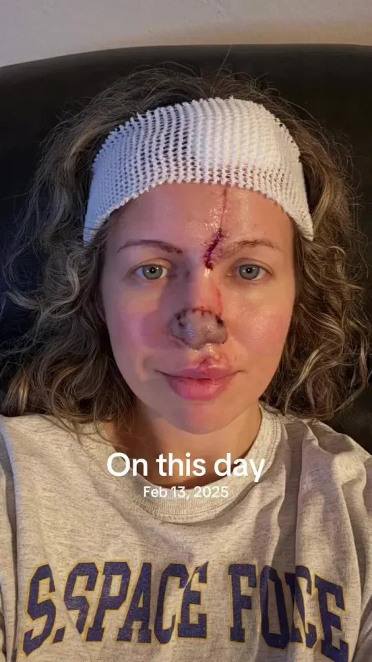 Influenszer akinek a kutyája leharapta az orrátInfluenszer akinek a kutyája leharapta az orrát