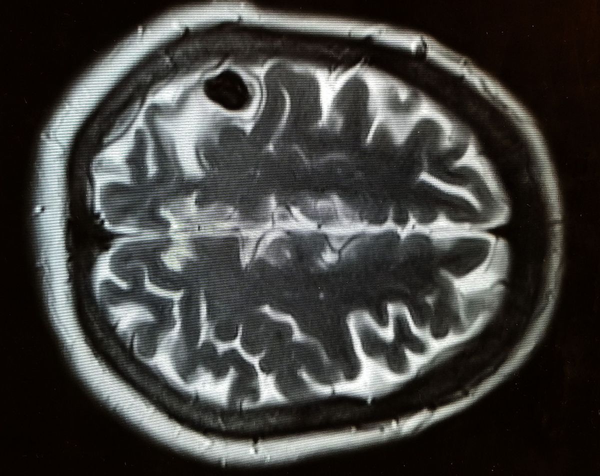Brain CT with Cysticercosis - Larva of Pork Tapeworm