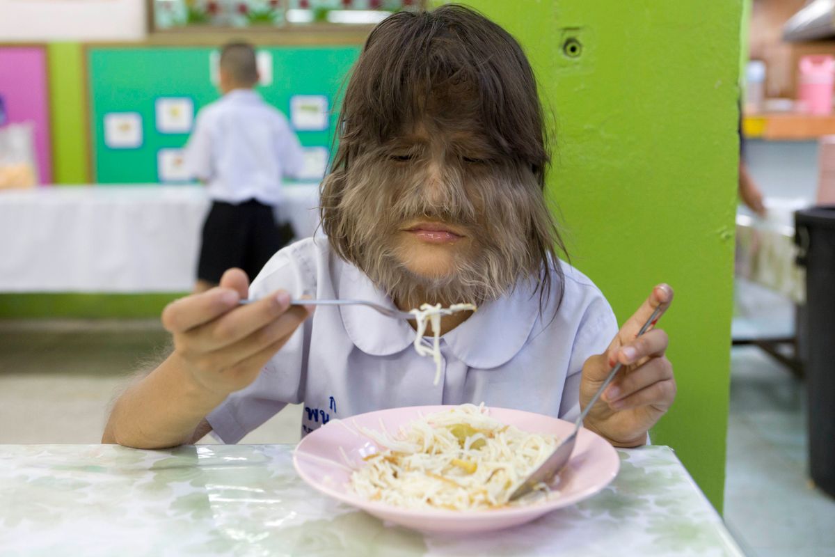 Vérfarkaslány: 2010-ben került be a Guiness-világrekordok könyvébe Supatra Sasupan, akit azóta is a világ legszőrösebb tinédzsereként tartanak számon.
