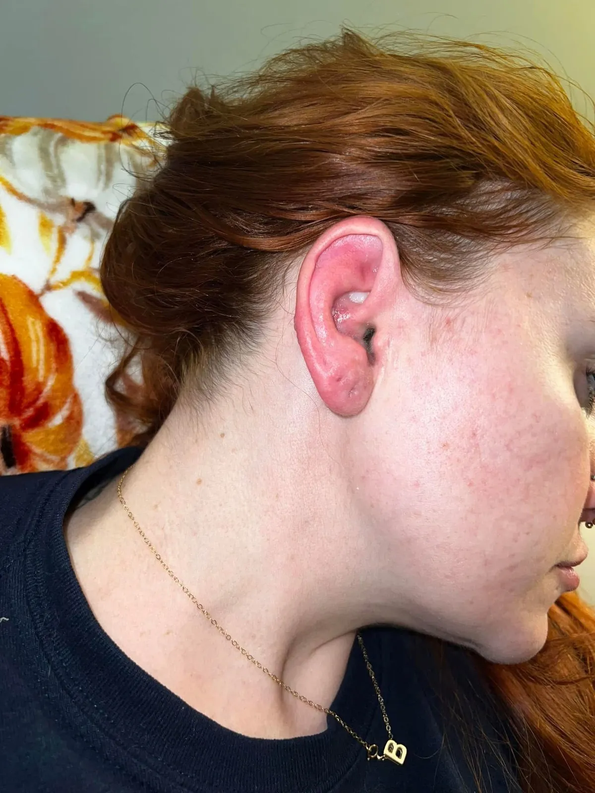 Kennedy News and Media (PIC SHOWS: KELLY STECH, 30, WOKE UP DAYS BEFORE HER WEDDING WITH A SWOLLEN AND BLISTERED RIGHT EAR) A bride became so stressed planning her big day it left her face PARALYSED - and unable to smile in wedding photos. Kelly Stech, who lives in Illinois, Chicago, US, had spent a year organising her dream wedding to her now-husband Benjamin Stech after becoming engaged in July 2022. The couple, who began dating in early-2020 after matching on Tinder, forked out $50,000 on their dream day. DISCLAIMER: While Kennedy News and Media uses its best endeavours to establish the copyright and authenticity of all pictures supplied, it accepts no liability for any damage, loss or legal action caused by the use of images supplied and the publication of images is solely at your discretion. SEE KENNEDY NEWS COPY - 0161 697 4266