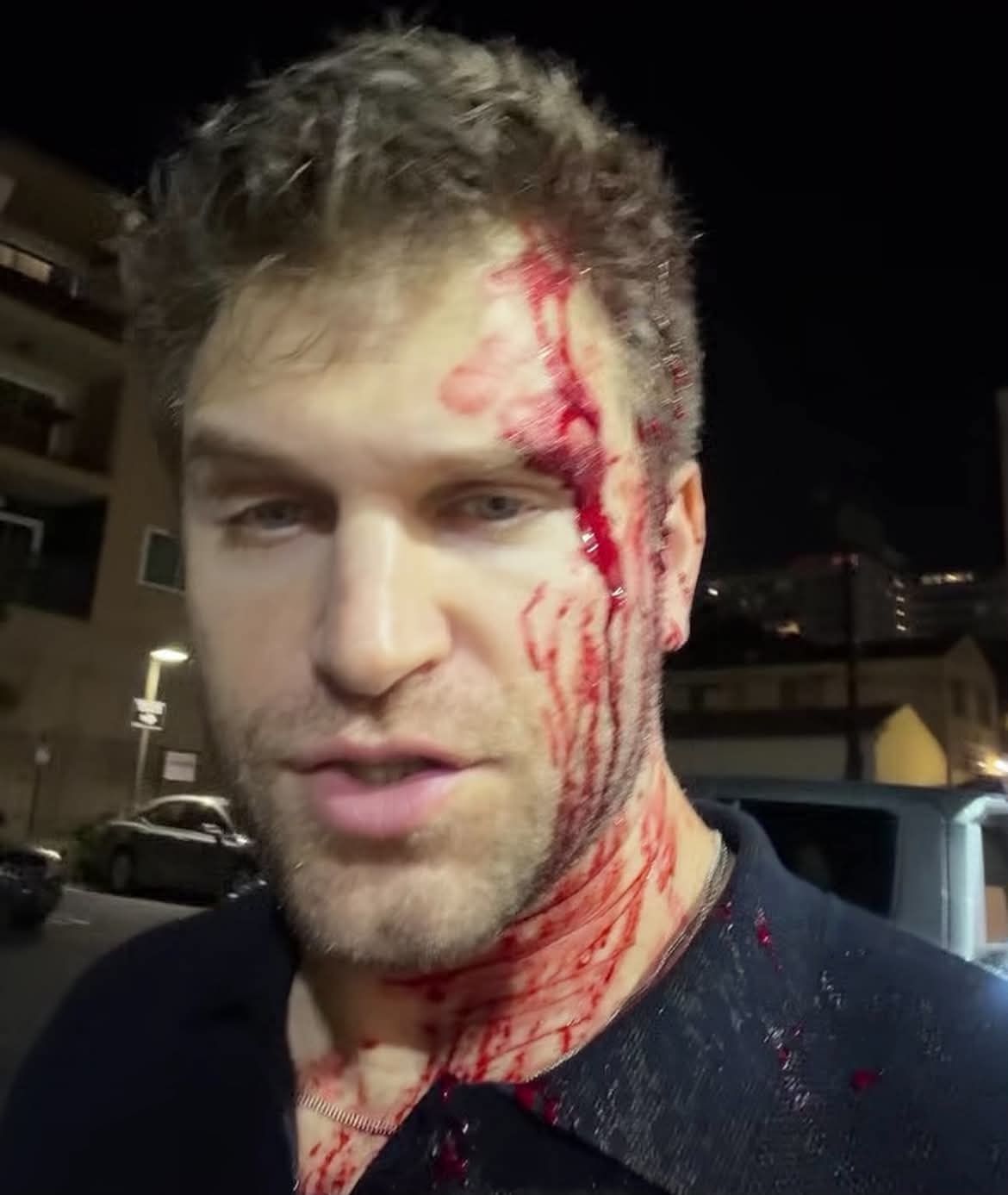Keegan Allen véres fejjel jelentkezett be Instagramon a támadás után.