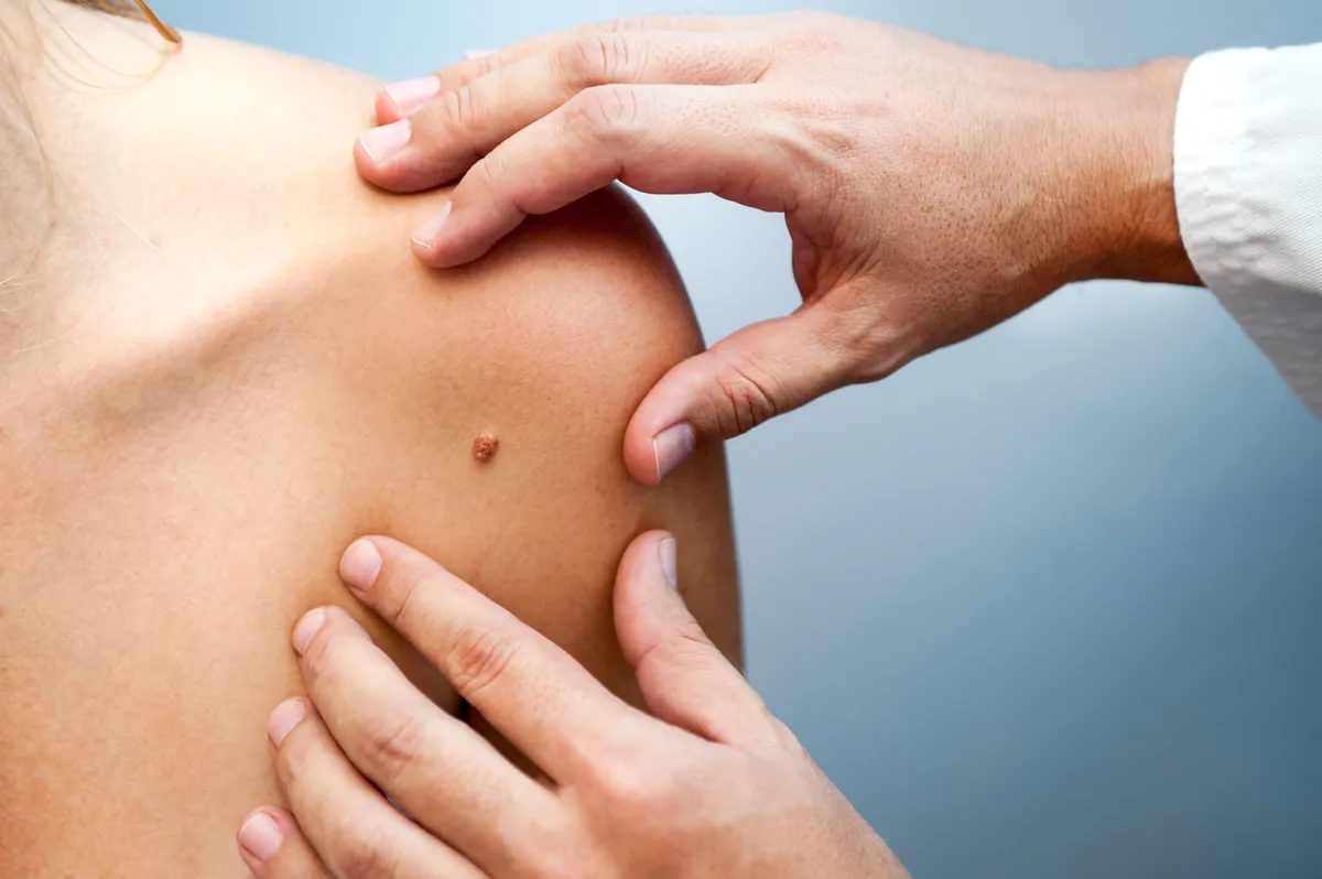 bőrgyógyász anyajegy szűrővizsgálat